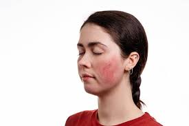makeup tips for rosacea skin how to