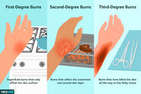 How Different Degrees Of Burns Are Treated