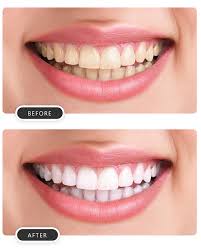teeth whitening tooth whitening in