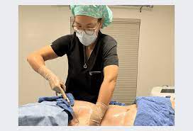 what is laser liposuction ultimate