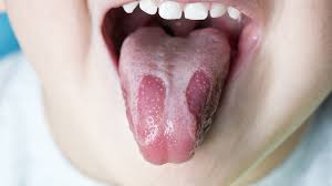 what is geographic tongue and what