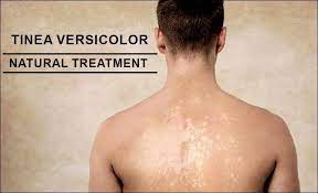 effective herbal remedy for tinea