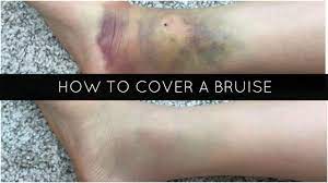 how to cover a bruise mikaelaabree