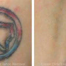Population has some sort of tattoo. Removery 127 Photos 56 Reviews Tattoo Removal 7400 Blanco Rd San Antonio Tx Phone Number Yelp