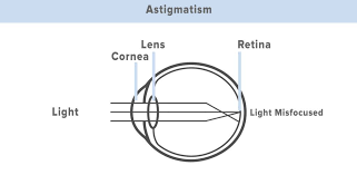 can lasik treat astigmatism
