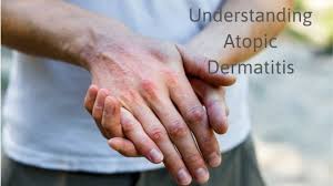 atopic dermais eczema