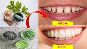Gaps between teeth can affect the esthetics of a smile, and also make it easier for food to get stuck. How To Fix Gap Between Teeth Naturally At Home Without Braces Health Pavilion Bright Side Youtube