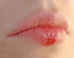 laser therapie gegen lippenherpes