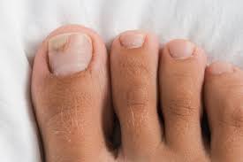 early se toenail fungus symptoms and