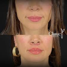 lip lift clinic p aesthetic surgery
