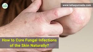 how to cure fungal infections of the