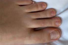 how to whiten dark toenails
