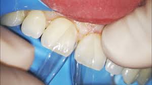 You don't need to get it fixed to your teeth like braces. How To Get Rid Of Gaps In Teeth Diastema Closure Options