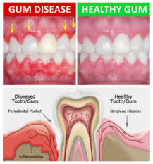 gum diseases treatment in oshawa