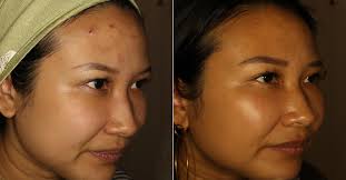 acne without prescription s