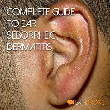 seborrheic dermais ear treatment