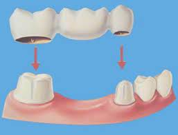 dental bridges cost types procedure