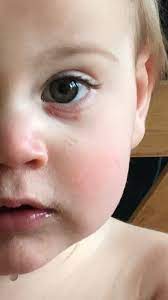 1 year old swollen rash under eye