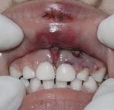 soft tissue injuries of the upper lip
