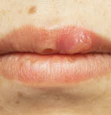 hiv mouth sores symptoms and