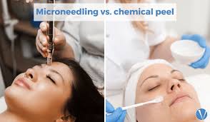 microneedling vs chemical l