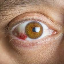 red eyes after lasik kugler vision