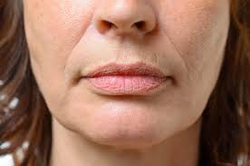 all about lip lines and how to get rid