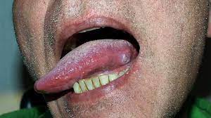 tongue cancer symptoms pictures