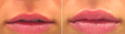 enhance your lips with lip fillers in