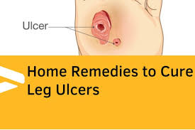 home remes to cure leg ulcers