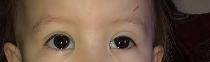 toddlers eyelid swollen october