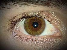 Heterochromia iridum - Wikipedia