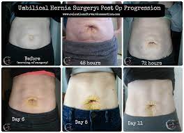 umbilical hernia surgery recovery