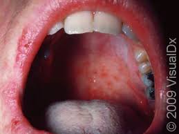 measles rubeola condition treatments