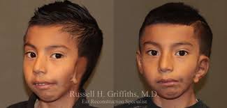 Case 1 - One Stage Microtia Reconstruction for Hemifacial Microsomia -  Before and After Gallery