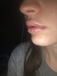 lower lip after juvederm injections