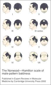 The Norwood Hamilton Scale Of Malepattern Baldness The