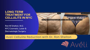 treatment for cellulite in nyc