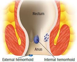 If blood pools in an external hemorrhoid and forms a clot (thrombus), it. Help For Hemorrhoids Harvard Health