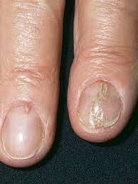 Maybe you would like to learn more about one of these? What Are The White Spots On Your Nails Trying To Tell You Everyday Health
