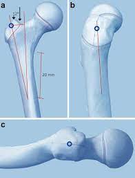 intramedullary nails for pediatric