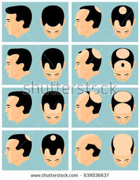 Hair Loss Classification Chart Related Keywords