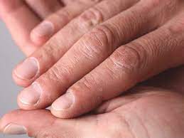 ridges in fingernails symptoms causes