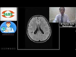 Check spelling or type a new query. Periventricular Leukomalacia Mri By Dr Sumer Sethi Youtube