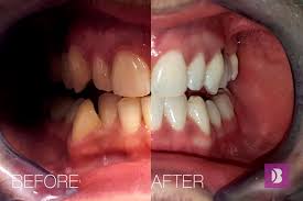 Es gibt viele moderne und wirksame methoden, um das weiß der zähne zu hause zurückzugeben. Zahnaufhellung B Dent Zahnpraxis Zagreb Kroatien
