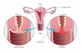 Symptoms of pelvic inflammatory disease. Cervicitis Harvard Health