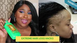 gastric byp causes hair loss deity