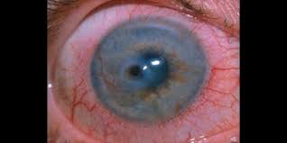cornea overview of corneal diseases