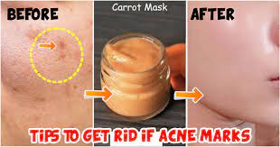 how to hide acne scars and blemishes