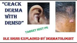 discoid lupus erythematosus clinical